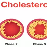 ये 4 exercises बहुत ही कम समय में करती हैं शरीर से Bad cholesterol बाहर
