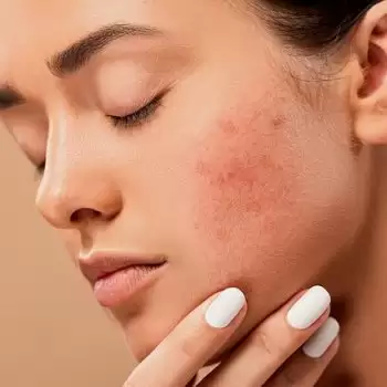 स्किन इंफेक्शन की समस्या, तो ऐसे करे जीरे का पैक का इस्तेमाल