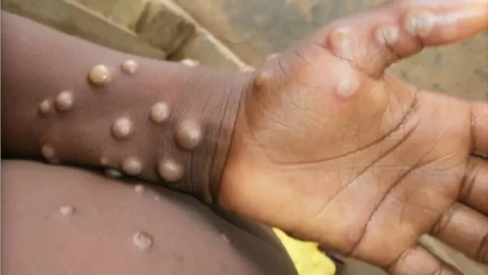 Monkeypox cases cross 70 thousand