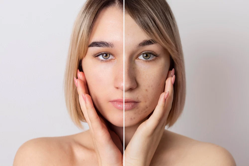 Pigmentation Removal