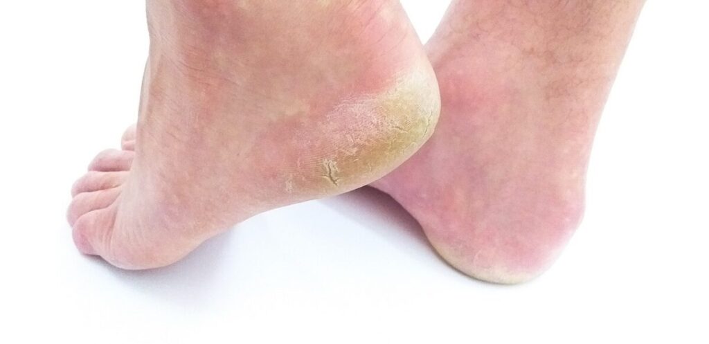 Cracked Heels Remedy