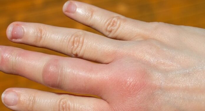 Fingers Swelling in Winter
