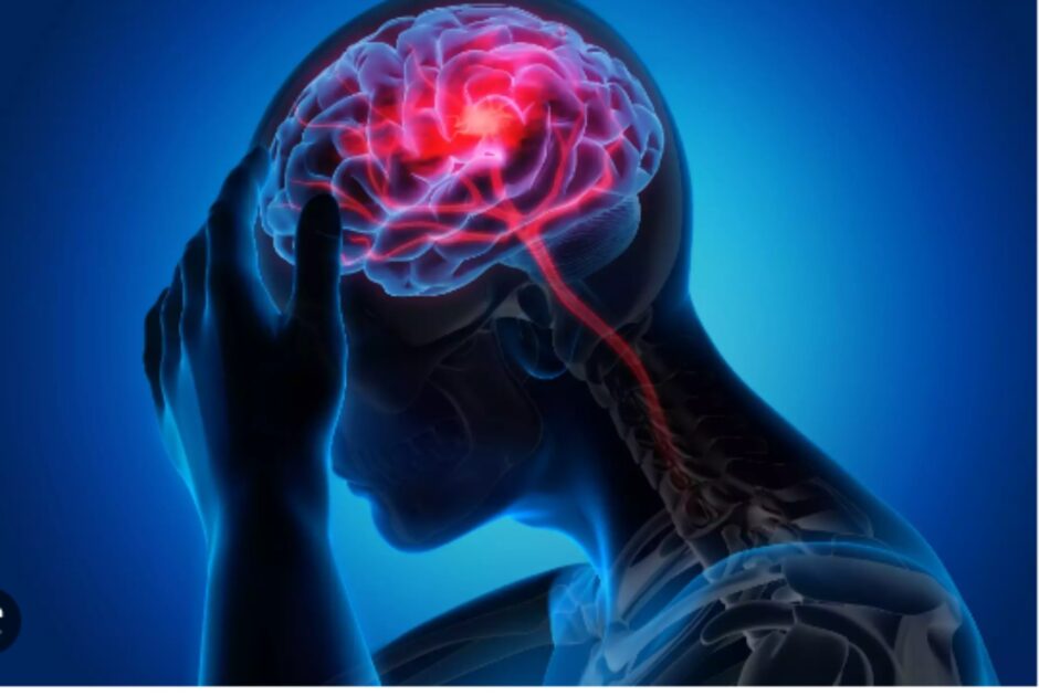 brain strock