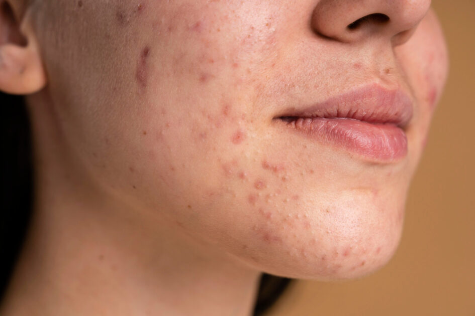 home remedies for scars and burns