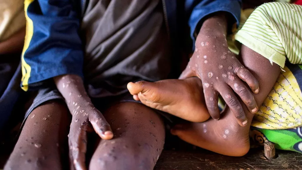 mpox